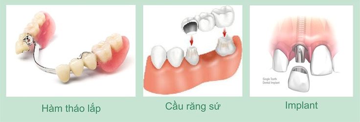 3 Cách trồng răng giả an toàn hiệu quả